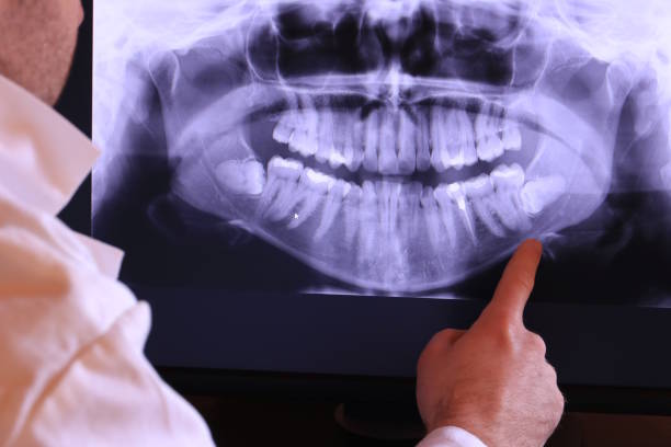 Best Knocked-Out Tooth (Avulsed Tooth) Treatment in Country Homes, WA