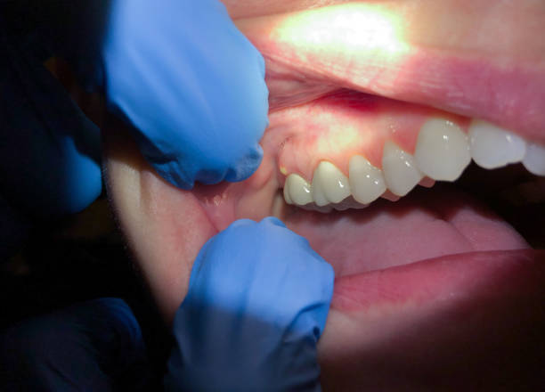 Best Emergency Care for Gum Disease in Country Homes, WA